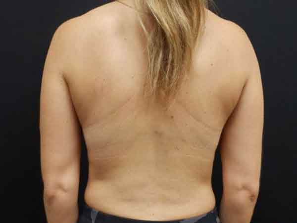 Liposuction — after