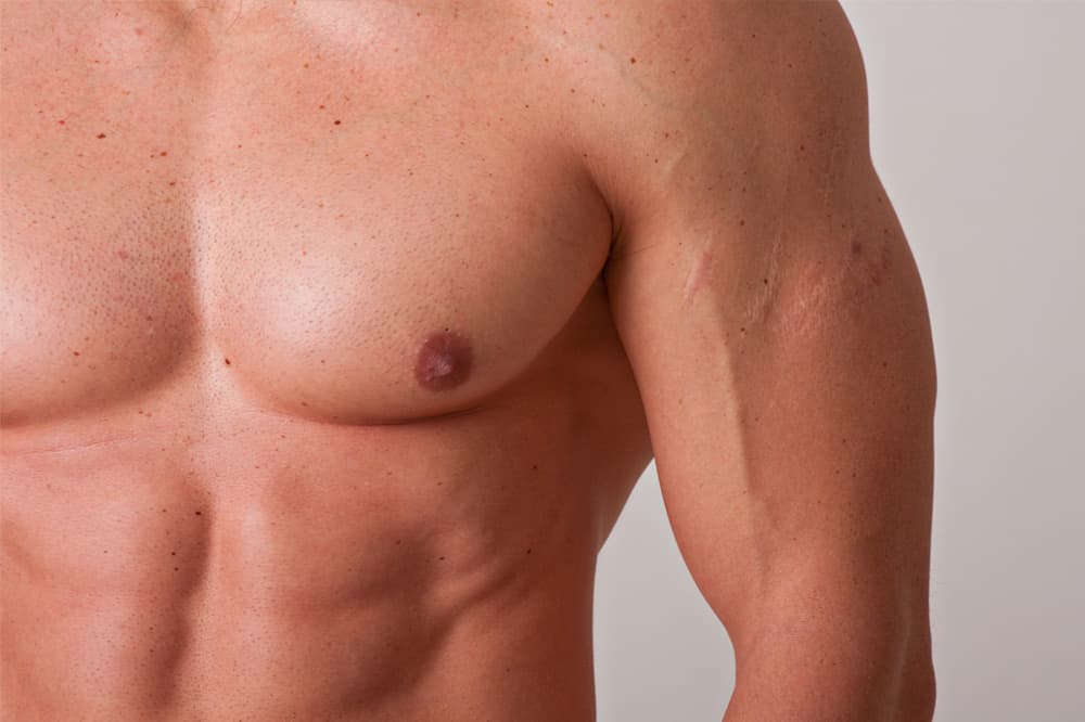 Male Breast Reduction